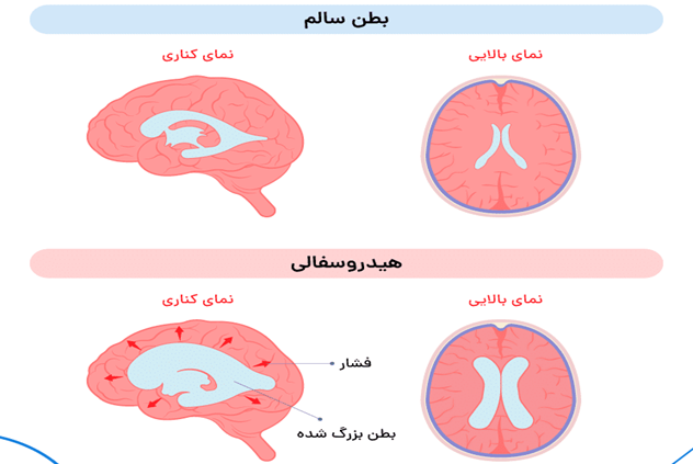 هیدروسفالی