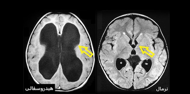 هیدروسفالی