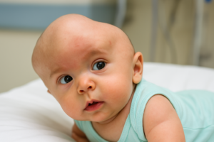 انواع کرانیوسینوستوز